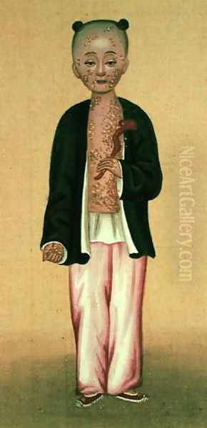 Child with smallpox (1) - view 1