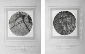 ``lecture On The Structure Of Cancerous Tumors And The Mode In Which Adjacent Parts Are Invaded' by Joseph Janvier Woodward