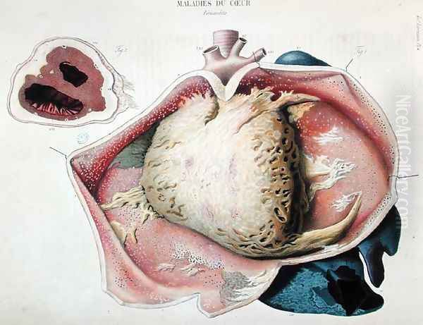 Pericarditis, plate depicting heart diseases from 'Anatomie pathologique du corps humain' by Antoine Chazal