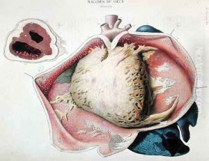 Pericarditis, plate depicting heart diseases from 'Anatomie pathologique du corps humain' by Antoine Chazal