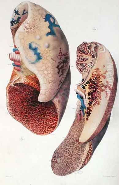 Pneumonia, from 'Anatomie Pathologique du Corps Humain' - view 1