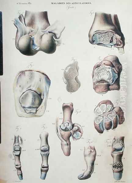 Diseases of the joints, from 'Anatomie Pathologique du Corps Humain' - view 1