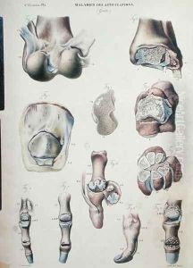 Diseases of the joints, from 'Anatomie Pathologique du Corps Humain' by Antoine Chazal