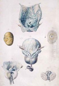 Diseases of the bladder and prostate, from 'Anatomie Pathologique du Corps Humain' by Antoine Chazal