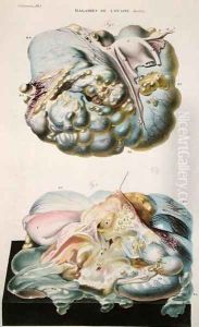 Diseases of the Ovaries, from 'Anatomie Pathologique du Corps Humain' by Antoine Chazal