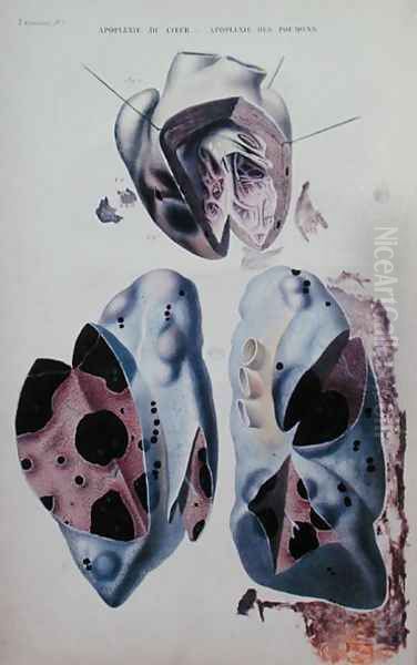 Apoplexy of the heart and of the lungs, illustration plate from 'Anatomie pathologique du corps humain' - view 1