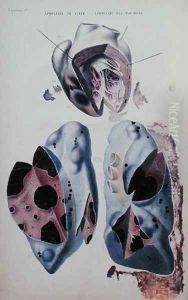 Apoplexy of the heart and of the lungs, illustration plate from 'Anatomie pathologique du corps humain' by Antoine Chazal