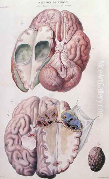 Cancerous tumours of the brain, from 'Anatomie Pathologique du Corps Humain' - view 1