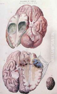Cancerous tumours of the brain, from 'Anatomie Pathologique du Corps Humain' by Antoine Chazal