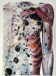 Tumours and cancerous tubercles, from 'Anatomie Pathologique du Corps Humain', 1828-42 by Antoine Chazal