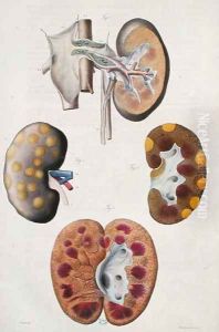 Diseases of the kidneys, from 'Anatomie Pathologique du Corps Humain' by Antoine Chazal