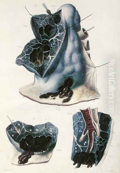 Diseases of the lungs, from 'Anatomie Pathologique du Corps Humain' - view 1