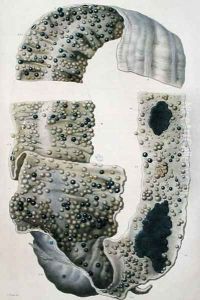 Diseases of the intestines, from 'Anatomie Pathologique du Corps Humain' by Antoine Chazal
