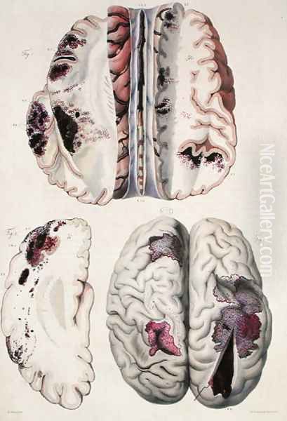 Capillary apoplexy, from 'Anatomie Pathologique du Corps Humain', 1828-42 - view 1