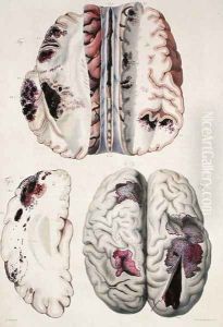 Capillary apoplexy, from 'Anatomie Pathologique du Corps Humain', 1828-42 by Antoine Chazal