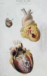 Plate depicting heart diseases. Spontaneous rupture of the heart of an 86 year old woman (fig. 1) and pericarditis in a six day old baby (fig. 2), from 'Anatomie pathologique du corps humain', 1828-42 by Antoine Chazal