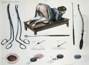 An operation on a vesicovaginal fistula by Nicolas Henri Jacob