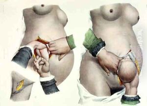 Birth by Caesarean