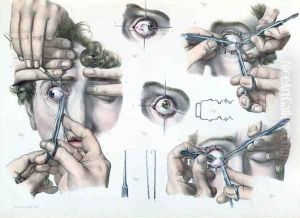 Operation on a strabismus by Nicolas Henri Jacob