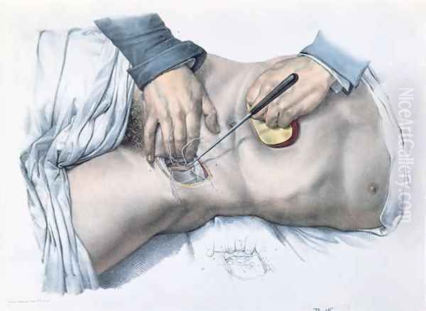 Tying up an artery - view 1
