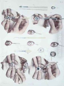 Operation on a eye by Nicolas Henri Jacob