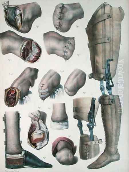 Amputations and Prosthetics - view 1