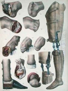 Amputations and Prosthetics by Nicolas Henri Jacob