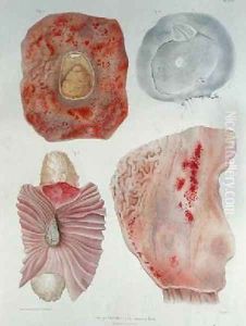 Organs infected with cholera