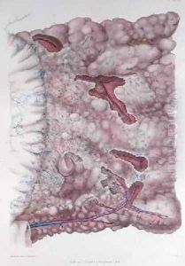 Cancer of the epiploon by Lackerbauer