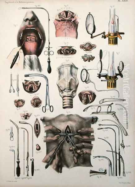 Tracheotomy operation, plate from Traite Complet de lAnatomie de lHomme by Jean-Baptiste Marc Bourgery 1797-1849 1866-67 - view 1