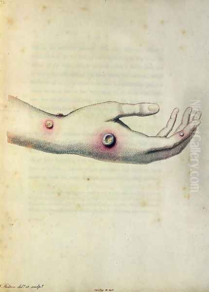 Cowpox pustule on the arm of Sarah Nelmes, from An Inquiry into the Causes and Effects of the Variolae Vaccinae by Edward Jenner 1749-1823 engraved by Pearce, c.1800 - view 1