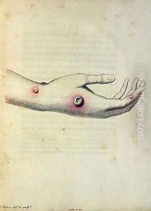 Cowpox pustule on the arm of Sarah Nelmes, from An Inquiry into the Causes and Effects of the Variolae Vaccinae by Edward Jenner 1749-1823 engraved by Pearce, c.1800