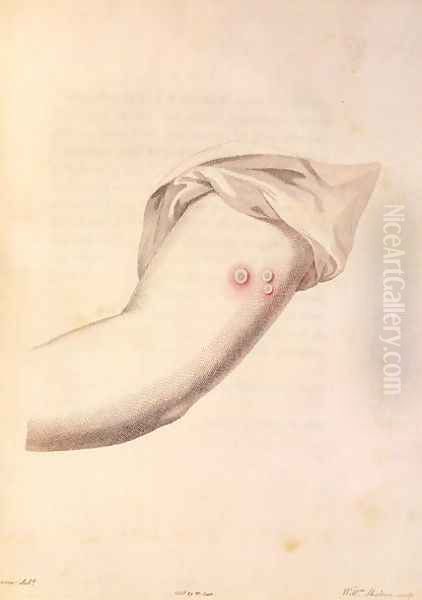 Arm of William Pead used for smallpox vaccine, from An Inquiry into the Causes and Effects of the Variolae Vaccinae by Edward Jenner 1748-1823 engraved by Pearce, c.1800 - view 1