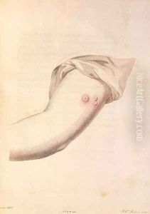 Arm of William Pead used for smallpox vaccine, from An Inquiry into the Causes and Effects of the Variolae Vaccinae by Edward Jenner 1748-1823 engraved by Pearce, c.1800