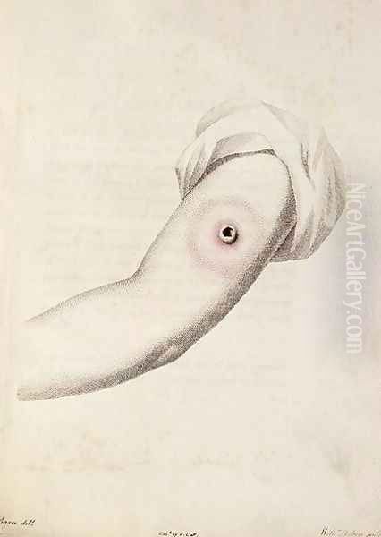 Cowpox pustule on an arm, from An Inquiry into the Causes and Effects of the Variolae Vaccinae by Edward Jenner 1749-1823 engraved by Pearce, c.1800 - view 1