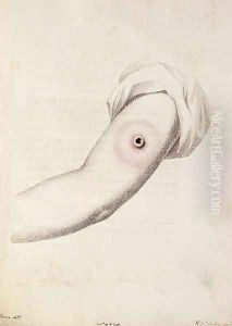 Cowpox pustule on an arm, from An Inquiry into the Causes and Effects of the Variolae Vaccinae by Edward Jenner 1749-1823 engraved by Pearce, c.1800