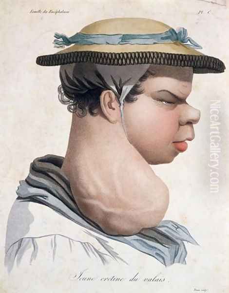 Young Cretin from Valais, illustration from a book by Baron Jean Louis Alibert 1768-1837 - view 1