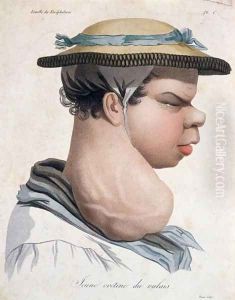 Young Cretin from Valais, illustration from a book by Baron Jean Louis Alibert 1768-1837