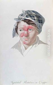 Syphilic cluster pustules, from a book by Baron Jean Louis Alibert 1768-1837 1838