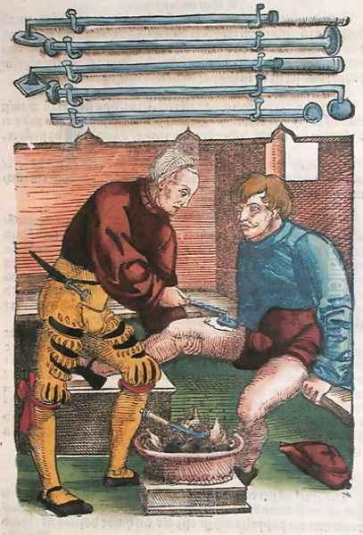 Cauterisation, illustration from Feldtbuch der Wundartzney by Hans von Gersdorff, c.1540 - view 1