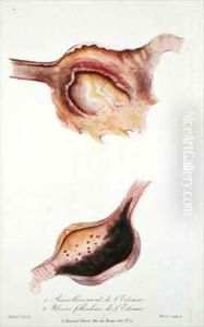 Softening and follicular ulcers of the stomach, from 'Traite des Maladies des Enfans Nouveaux-Nes et a la Mamelle' by Charles-Michel Billard