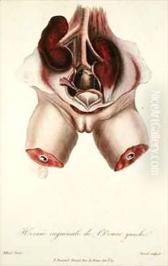 Inguinal hernia of the left ovary, from 'Traite des Maladies des Enfans Nouveaux-Nes et a la Mamelle' by Charles-Michel Billard