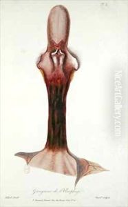 Gangrene of the oesophagus, from 'Traite des Maladies des Enfans Nouveaux-Nes et a la Mamelle' by Charles-Michel Billard