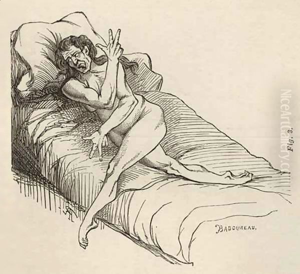 Hysterical epilepsy, attack, contortions - view 1