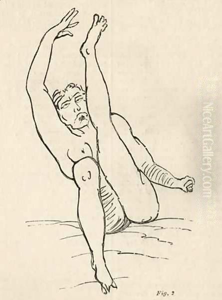 Hysterical epilepsy, attack, contortions 3 - view 1