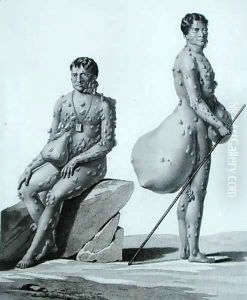 Northern Mariana Islands: Two Men Suffering from Tuberculosis, from 'Voyage Autour du Monde sur les Corvettes de L'Uranie 1817-20' by Jacques Etienne Victor Arago